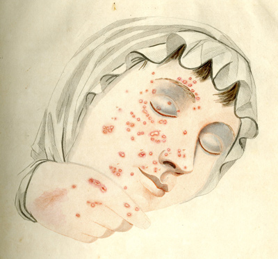 Fisher's illustration of a patient with smallpox